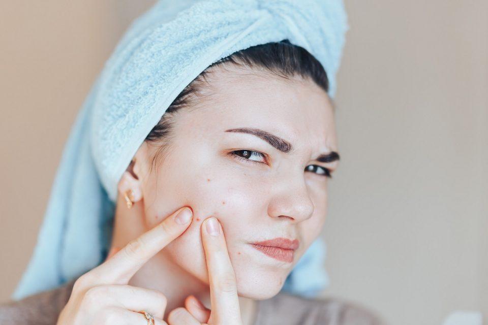 AKNE – TOP SAVJETI ZA NAJČEŠĆI DERMATOLOŠKI PROBLEM